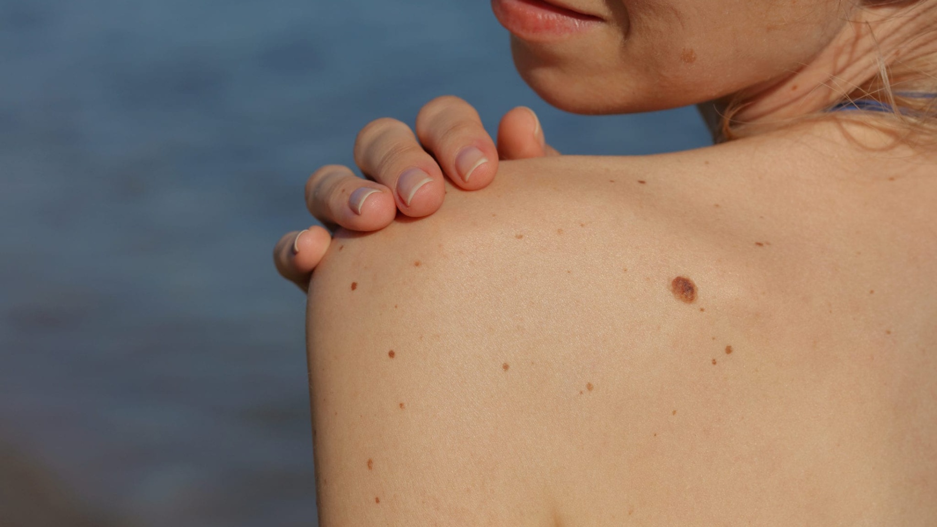 Melanoma, 10 mite dhe të vërteta për kancerin e lëkurës!